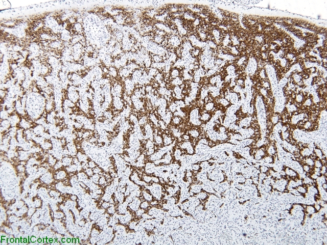 Angiocentric glioma synaptophysi